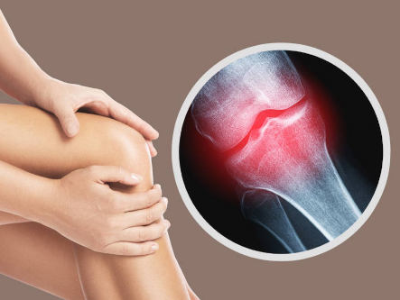 arthrose-ganheitlich-heilen-holistische-behandlung-naturheilkunde-gesundheitsindex-333